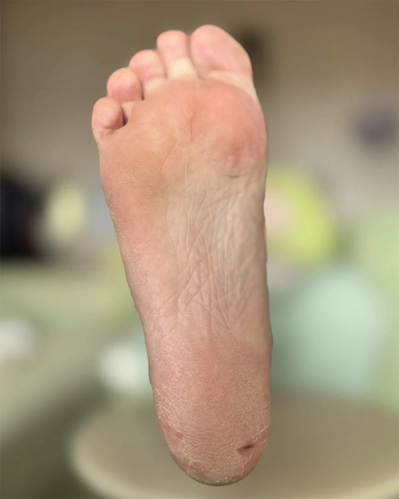 ТРЕЩИНА НА ПЯТКЕДО ПРОЦЕДУРЫ