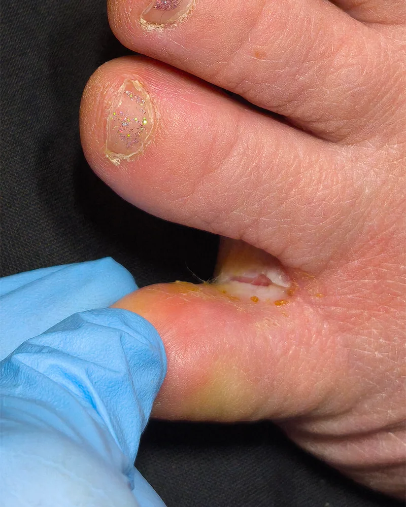 ChatGPT сказал: Mikrolõhe varvaste vahel — foto enne protseduuri