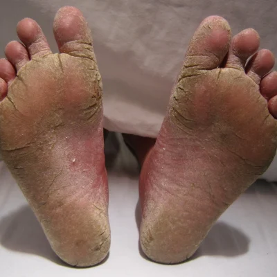 Jalgade viirused ja haigused 3